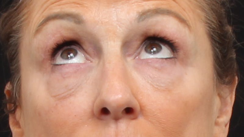 Upper Blepharoplasty Before & After Gallery - Patient 129200 - Image 7