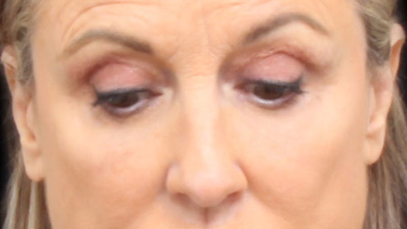 Upper Blepharoplasty Before & After Gallery - Patient 129200 - Image 4