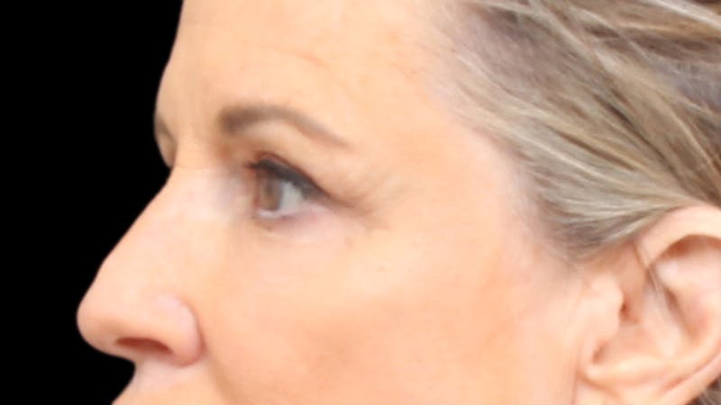 Upper Blepharoplasty Before & After Gallery - Patient 129200 - Image 6