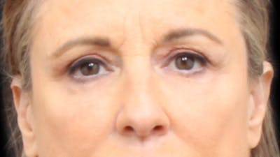 Lower Blepharoplasty Before & After Gallery - Patient 756601 - Image 2