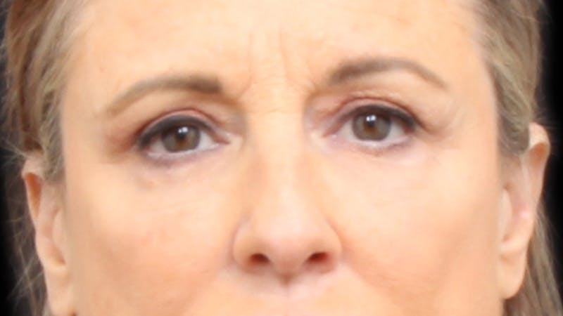Upper Blepharoplasty Before & After Gallery - Patient 129200 - Image 2