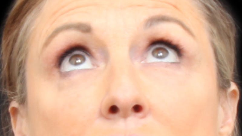 Upper Blepharoplasty Before & After Gallery - Patient 129200 - Image 8
