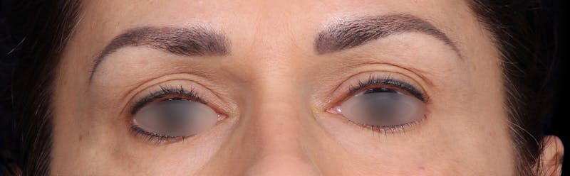 Upper Blepharoplasty Before & After Gallery - Patient 402567 - Image 1