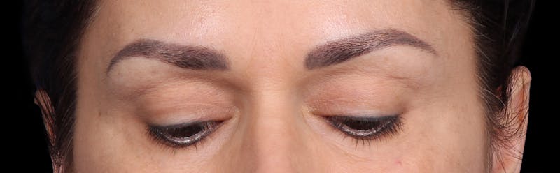 Upper Blepharoplasty Before & After Gallery - Patient 402567 - Image 3