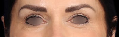 Upper Blepharoplasty Before & After Gallery - Patient 402567 - Image 2