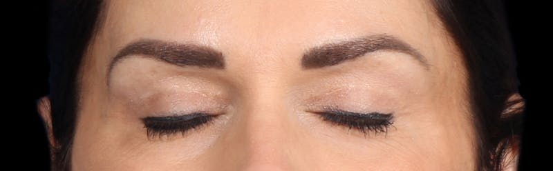 Upper Blepharoplasty Before & After Gallery - Patient 402567 - Image 4