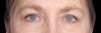 Upper Blepharoplasty Before & After Gallery - Patient 405279 - Image 1