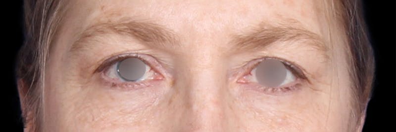 Upper Blepharoplasty Before & After Gallery - Patient 405279 - Image 1