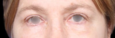 Upper Blepharoplasty Before & After Gallery - Patient 405279 - Image 2