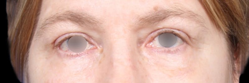 Upper Blepharoplasty Before & After Gallery - Patient 405279 - Image 2