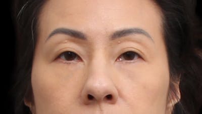 Upper Blepharoplasty Before & After Gallery - Patient 846668 - Image 1