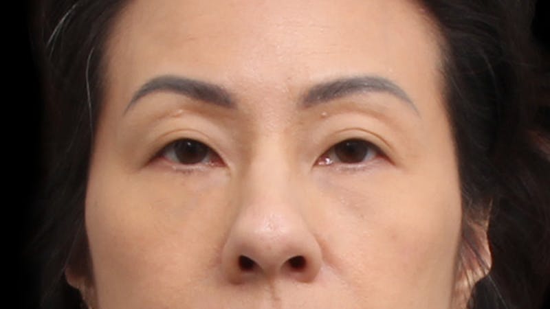 Upper Blepharoplasty Before & After Gallery - Patient 846668 - Image 1