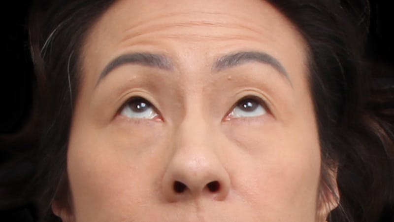 Upper Blepharoplasty Before & After Gallery - Patient 846668 - Image 7