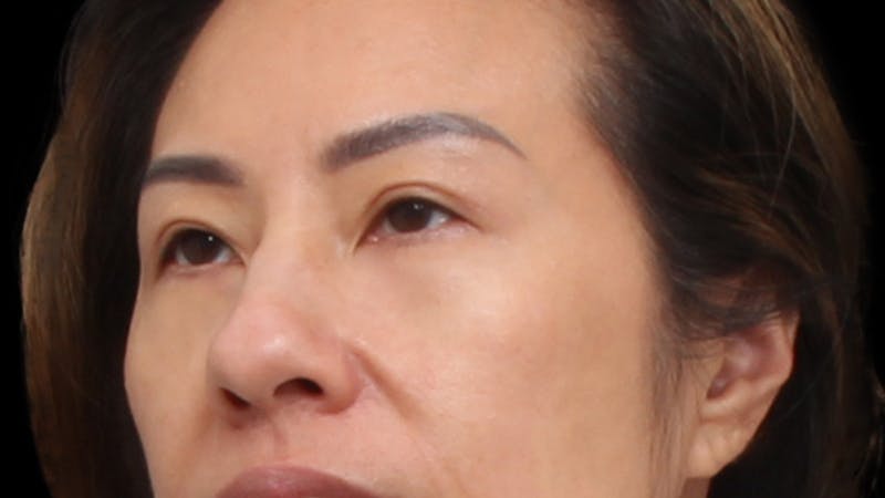 Upper Blepharoplasty Before & After Gallery - Patient 846668 - Image 4