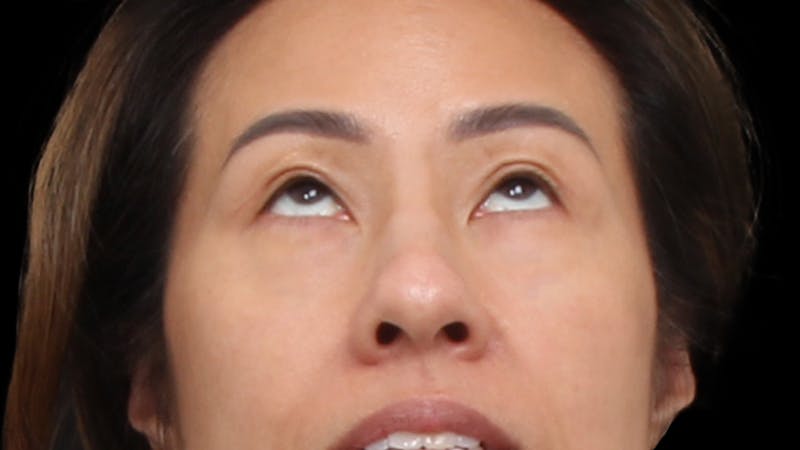 Upper Blepharoplasty Before & After Gallery - Patient 846668 - Image 8