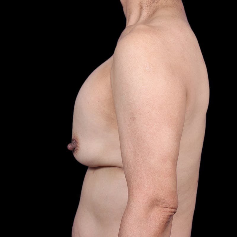 Breast Implant Revision Before & After Gallery - Patient 389898 - Image 9