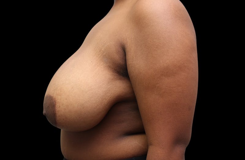 Breast Reduction Before & After Gallery - Patient 199098 - Image 9