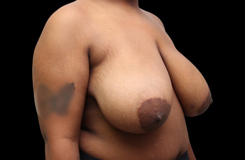 Breast Reduction Before & After Gallery - Patient 199098 - Image 5