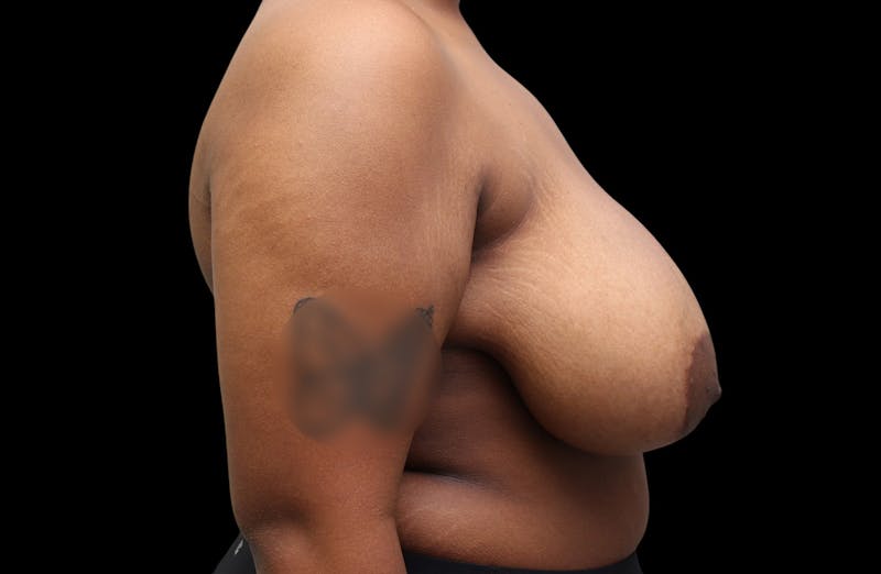 Breast Reduction Before & After Gallery - Patient 199098 - Image 7