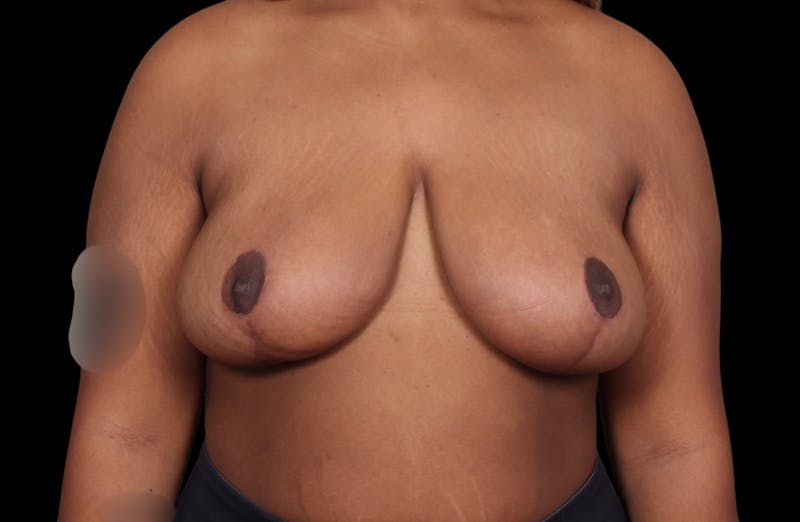 Breast Reduction Before & After Gallery - Patient 199098 - Image 2