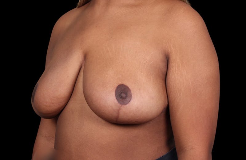 Breast Reduction Before & After Gallery - Patient 199098 - Image 4