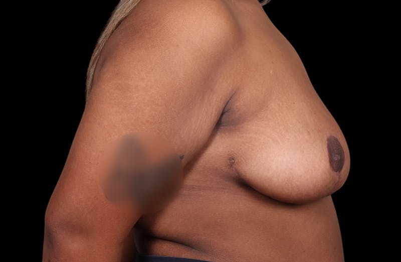Breast Reduction Before & After Gallery - Patient 199098 - Image 8