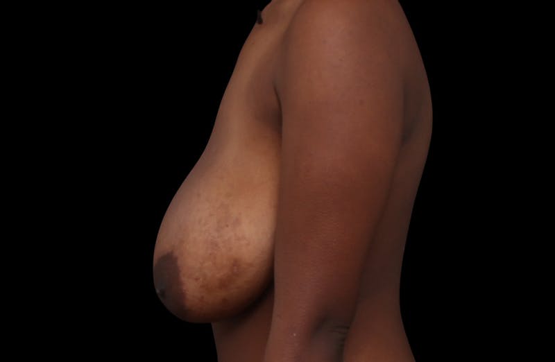 Breast Reduction Before & After Gallery - Patient 382571 - Image 7