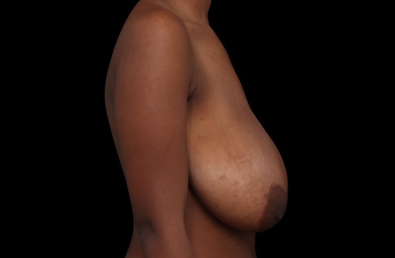 Breast Reduction Before & After Gallery - Patient 382571 - Image 9