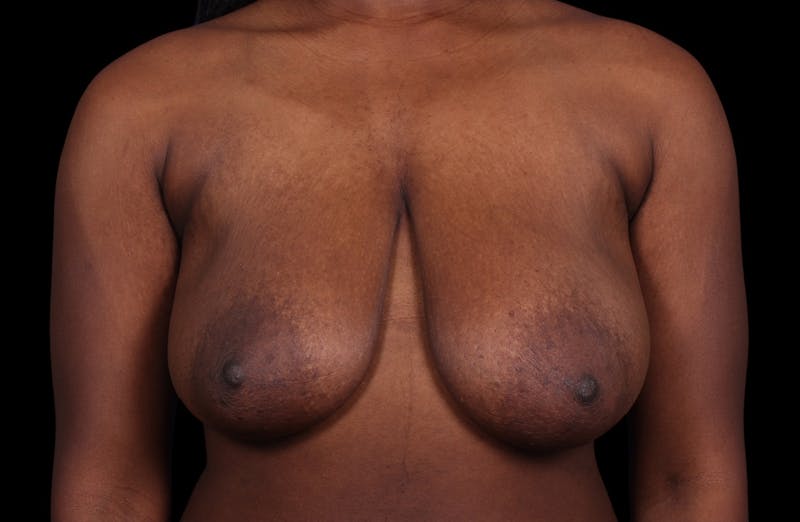 Breast Reduction Before & After Gallery - Patient 787772 - Image 1