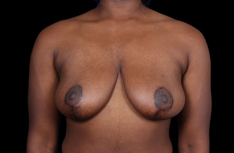 Breast Reduction Before & After Gallery - Patient 787772 - Image 2