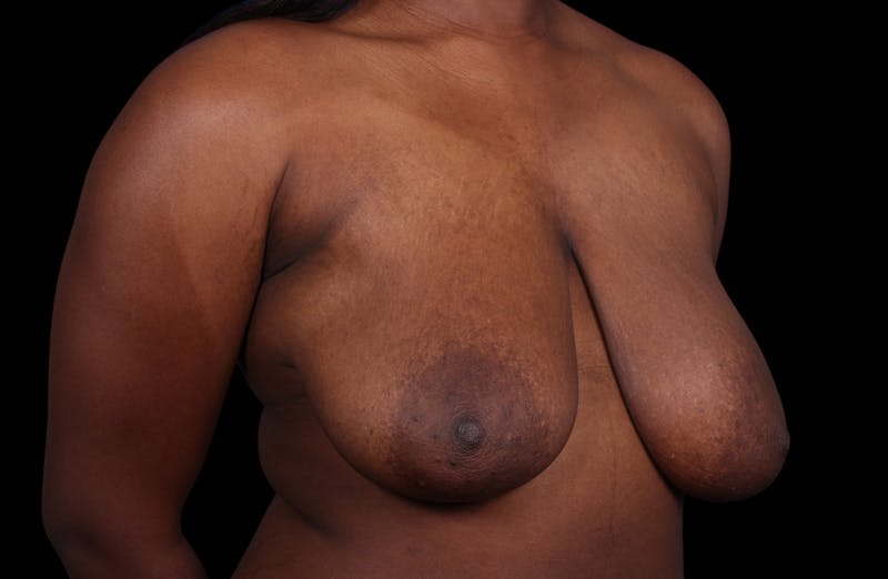 Breast Reduction Before & After Gallery - Patient 787772 - Image 3