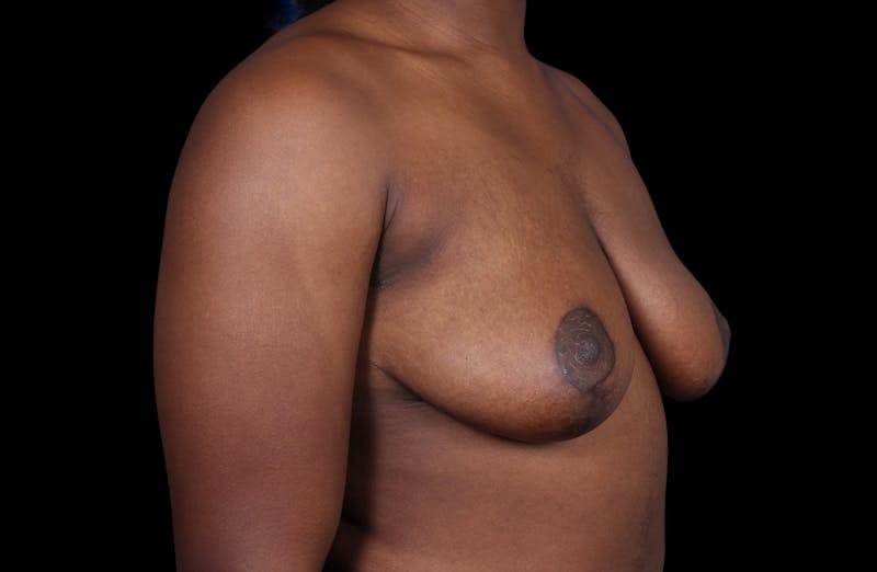 Breast Reduction Before & After Gallery - Patient 787772 - Image 4