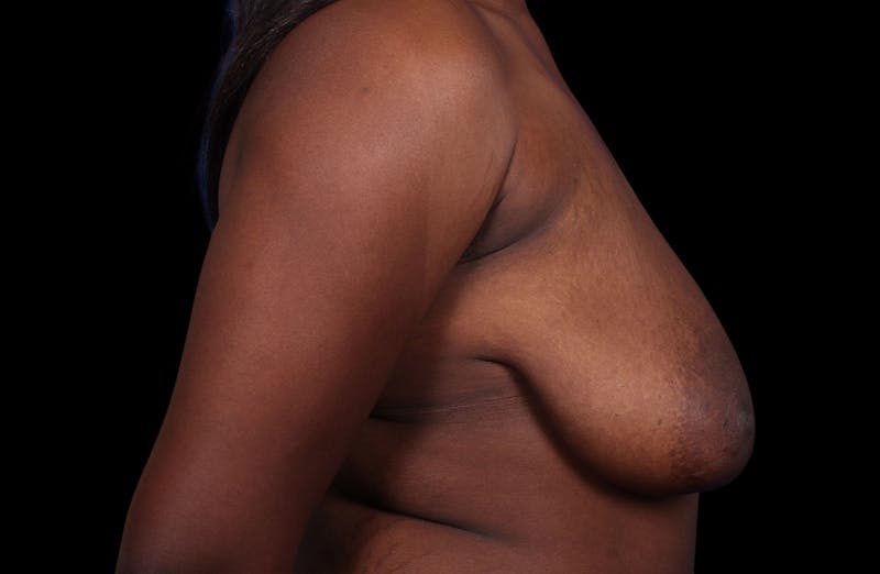 Breast Reduction Before & After Gallery - Patient 787772 - Image 5