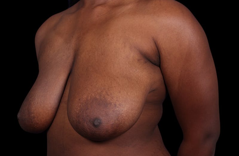 Breast Reduction Before & After Gallery - Patient 787772 - Image 7