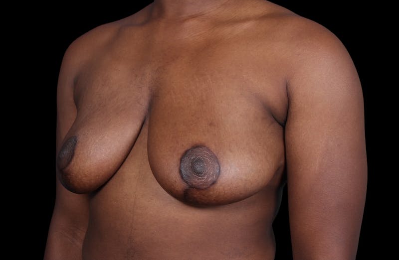 Breast Reduction Before & After Gallery - Patient 787772 - Image 8