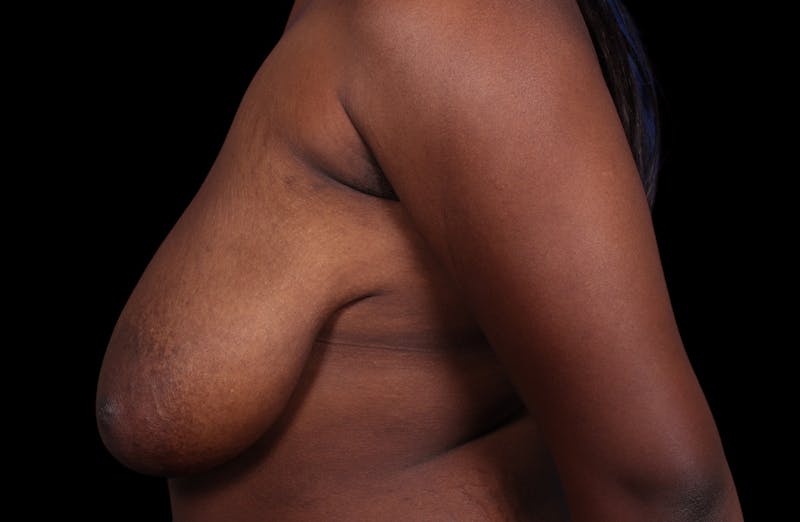 Breast Reduction Before & After Gallery - Patient 787772 - Image 9
