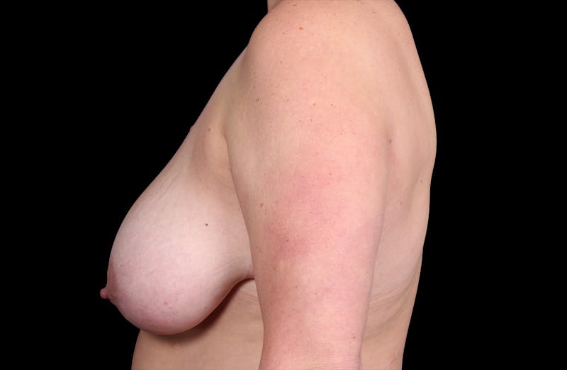Breast Reduction Before & After Gallery - Patient 140470 - Image 9