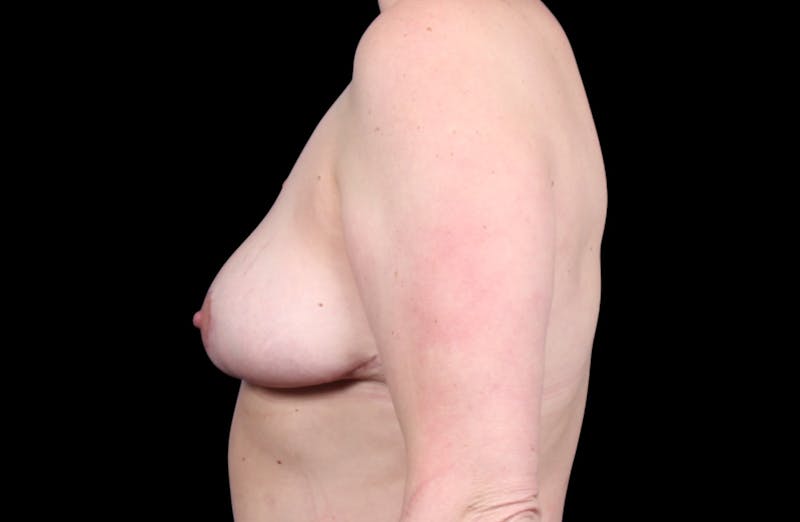 Breast Reduction Before & After Gallery - Patient 140470 - Image 10