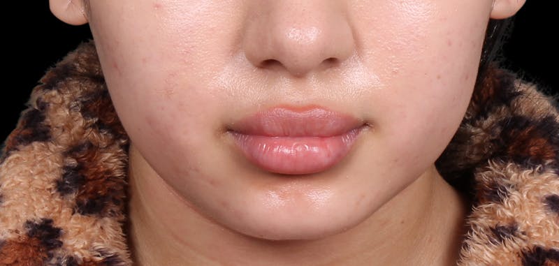 Buccal Fat Removal Before & After Gallery - Patient 187794 - Image 5