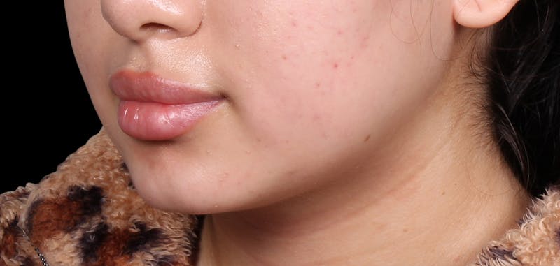 Buccal Fat Removal Before & After Gallery - Patient 187794 - Image 3