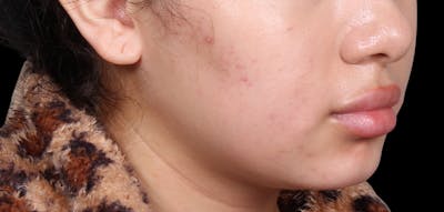 Buccal Fat Removal Before & After Gallery - Patient 187794 - Image 1