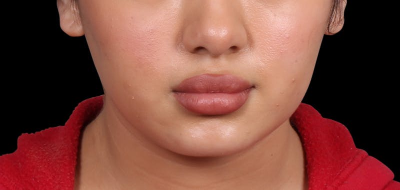 Buccal Fat Removal Before & After Gallery - Patient 187794 - Image 6
