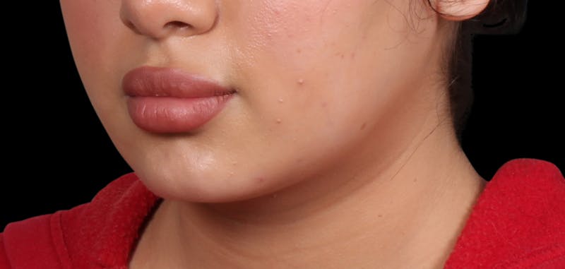 Buccal Fat Removal Before & After Gallery - Patient 187794 - Image 4