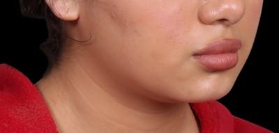 Buccal Fat Removal Before & After Gallery - Patient 187794 - Image 2