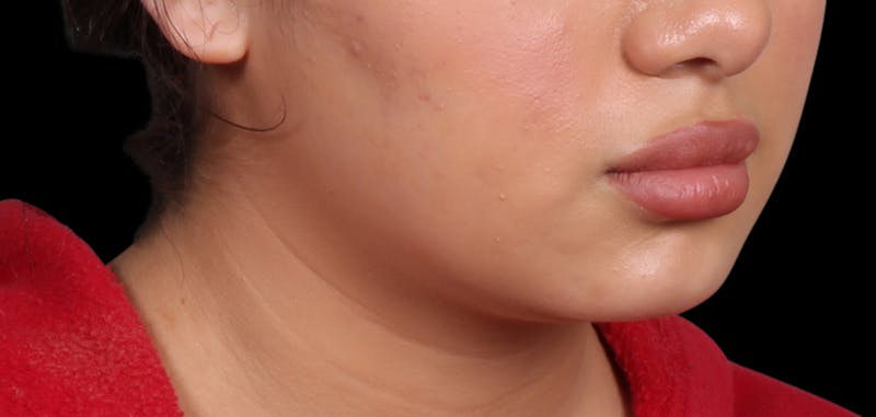 Buccal Fat Removal Before & After Gallery - Patient 187794 - Image 2