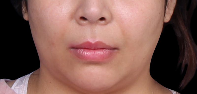 Buccal Fat Removal Before & After Gallery - Patient 423076 - Image 3