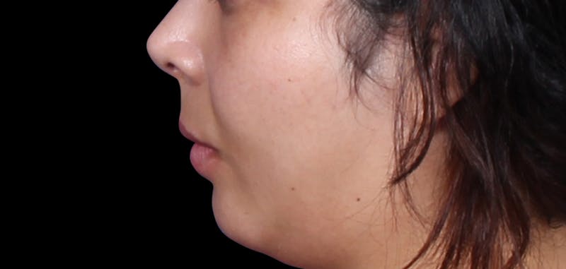 Buccal Fat Removal Before & After Gallery - Patient 423076 - Image 5