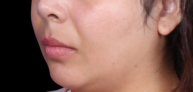 Buccal Fat Removal Before & After Gallery - Patient 423076 - Image 7