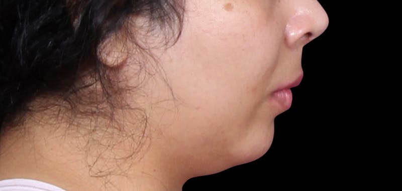 Buccal Fat Removal Before & After Gallery - Patient 423076 - Image 9
