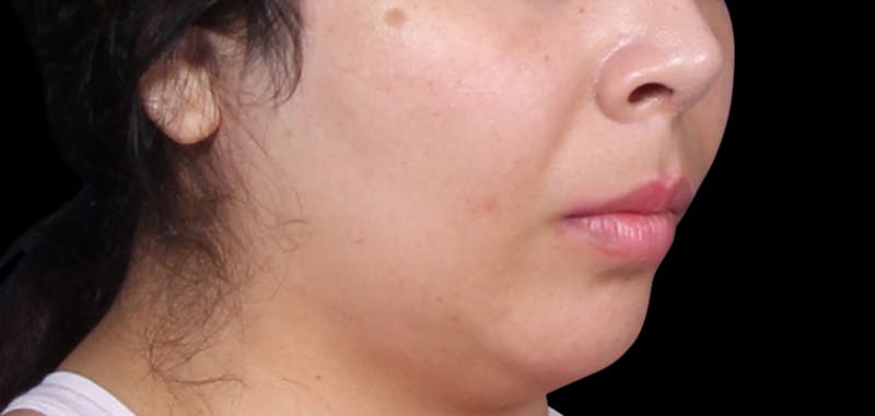 Buccal Fat Removal Before & After Gallery - Patient 423076 - Image 1